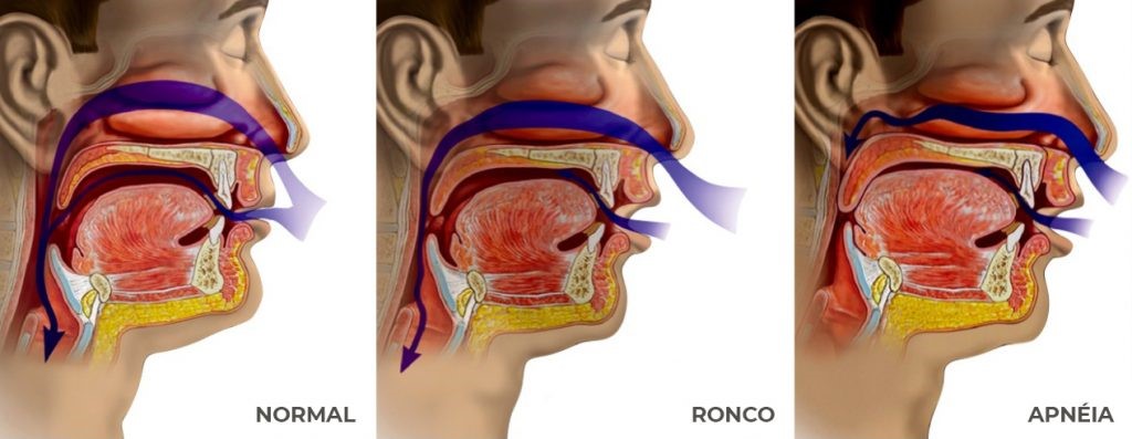 Ronco e Apneia do Sono – Implantes Dentários